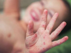 Measles continues to spread in Banke